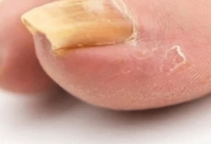 gljivice na noktima